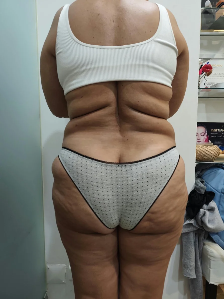 Antes, registo clínico corporal em vista posterior